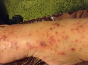 image of foot rash first week