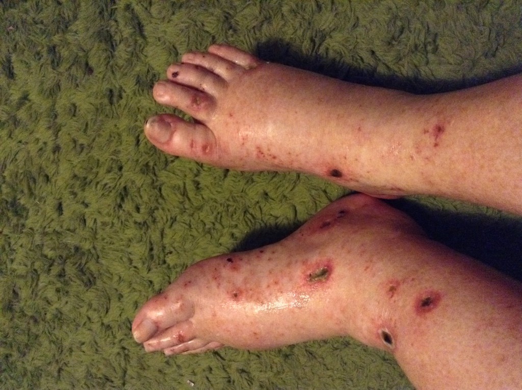 Image of feet and leg ulcers